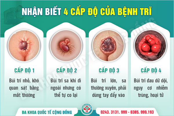 Cách chữa bệnh lòi dom được 99% bệnh nhân tin tưởng, thực hư thế nào?