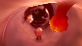 Polyp hậu môn