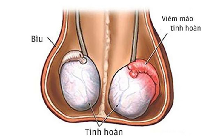 Bệnh về tinh hoàn
