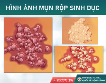 Mụn rộp sinh dục nhận biết thế nào? Đừng bỏ qua những dấu hiệu này!