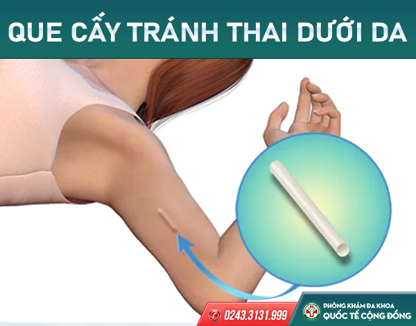 Cấy que tránh thai – Giải pháp tuyệt vời cho chuyện “ấy”