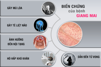 Giang mai có dấu hiệu gì? Chớ chủ quan nếu thấy những biểu hiện này!