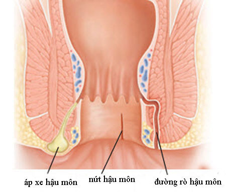Bệnh hậu môn