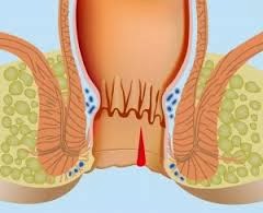 Nứt kẽ hậu môn