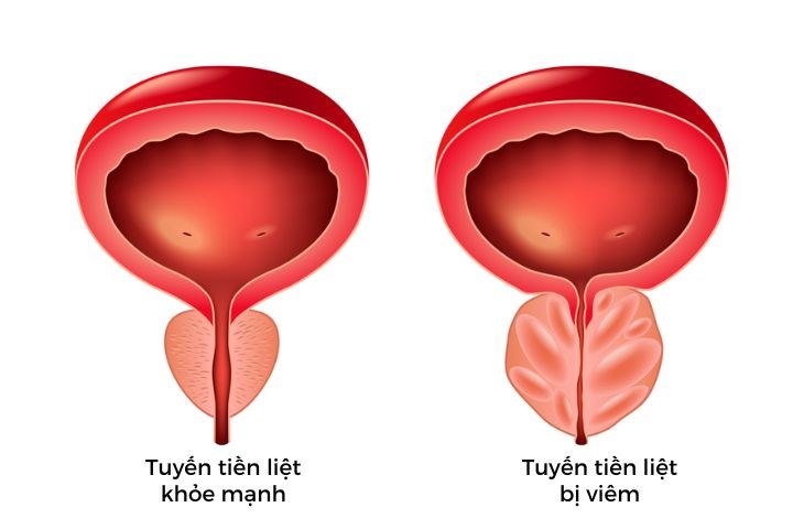 Bệnh tiền liệt tuyến