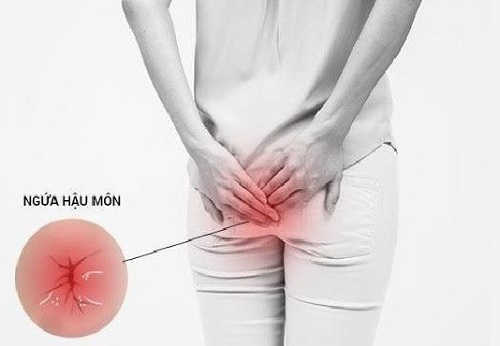 Ngứa hậu môn
