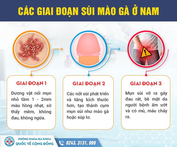Dấu hiệu sùi mào gà – Cách nhận diện không phải ai cũng biết