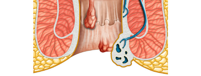 Trĩ hỗn hợp