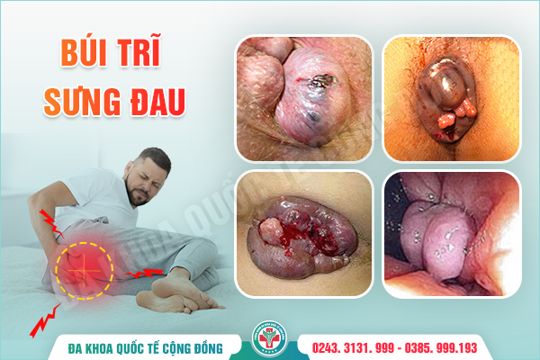 Điều Trị Đau Búi Trĩ: Làm Sao Để Dứt Điểm Cảm Giác Khó Chịu?