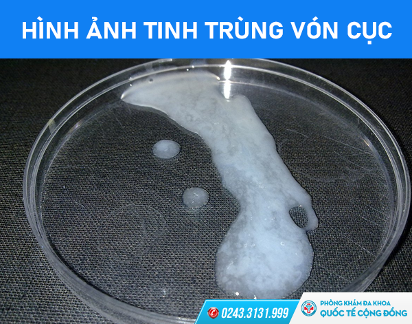 Nguy hại gặp phải khi tinh trùng bị vón cục – Địa chỉ điều trị tinh trùng vón cục uy tín