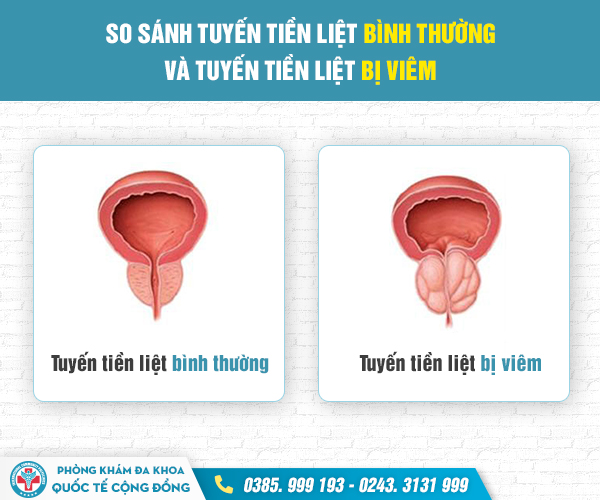 Bệnh viêm tuyến tiền liệt và những điều cần biết