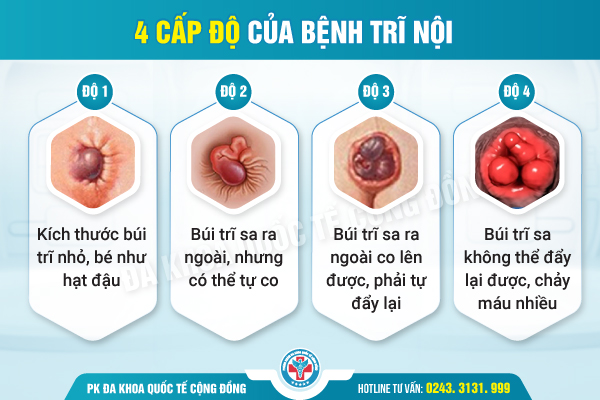 Tổng quan trĩ nội và công nghệ hỗ trợ điều trị hiệu quả từ chuyên gia
