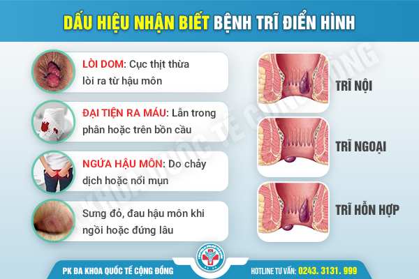 Búi Trĩ Sưng Đau: Dấu Hiệu Báo Động Người Bệnh Không Thể Chần Chừ Thêm